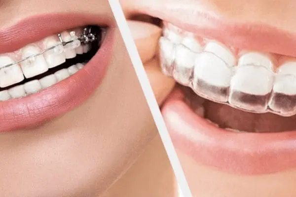 A Guide to Orthodontic treatments